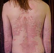 psoriasis