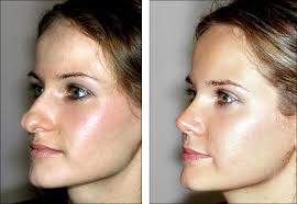 rhinoplasty