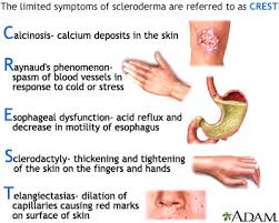 scleroderma