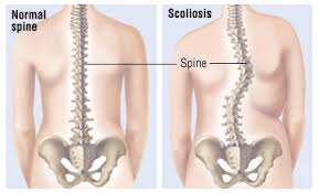 scoliosis