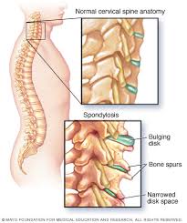 spondylosis