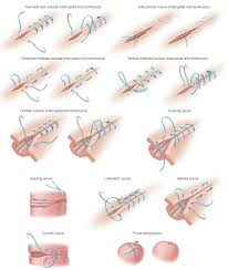 suture