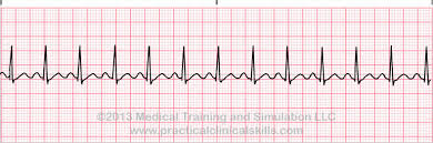 tachycardia