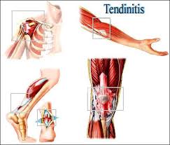 tendinitis