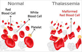 thalassemia