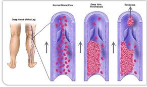 thrombosis