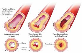 thrombus