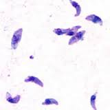 toxoplasmosis