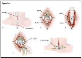 tracheotomy