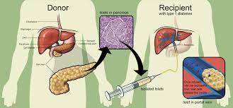 transplantation