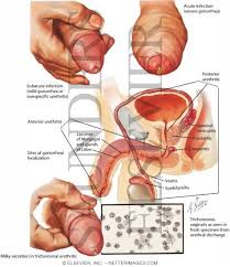 urethritis