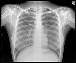 x-ray